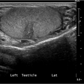 Left testicle mass
