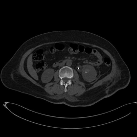 Unenhanced axial abdominal CT