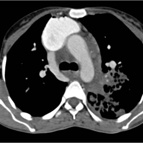 Axial CECT examination of thorax in mediastinal window