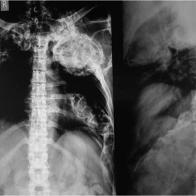 X-ray DL spine