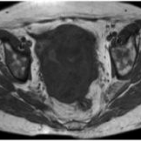 Axial non-enhanced T1-weighted MR image