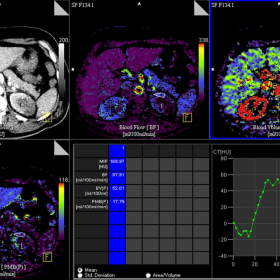 Perfusion CT imaging normal parameters