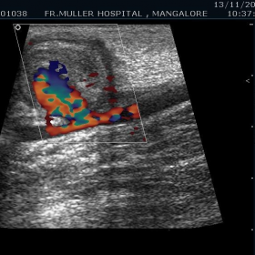 Upper limb ultrasound with Doppler