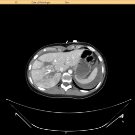 Imaging CT  liver trauma