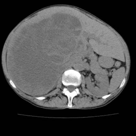 Multiphase contrast-enhanced CT