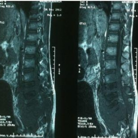 Sagittal lumbosacral MRI