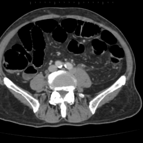 MSCT axial. Level below bifurcation of abdominal aorta