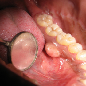 Intra-oral view of a swelling on the left side