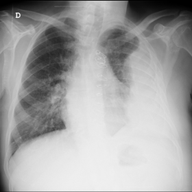 Chest radiograph, frontal view