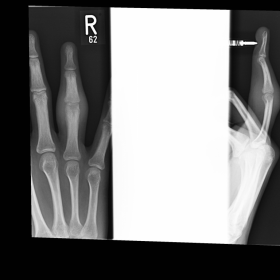 Initial finger X-ray