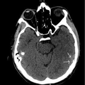 Non-contrasted CT of the brain
