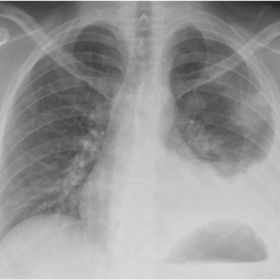 Intial Chest Radiograph