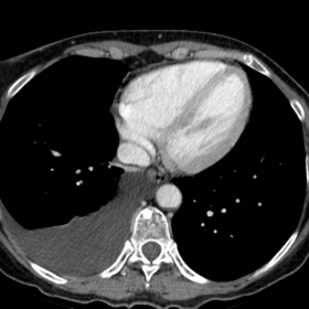Contrast-enhanced CT of the chest.