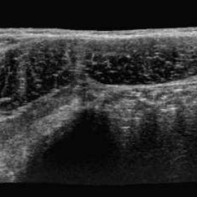 Transverse panoramic grey scale ultrasound of the anterolateral abdominal muscles