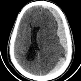 CT brain - axial