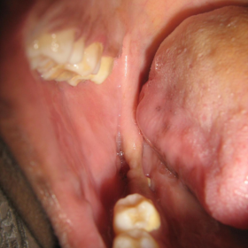 Intra-oral photograph of patient