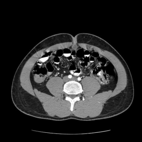 Axial contrast enhanced CT of the abdomen