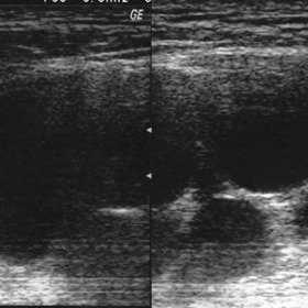 Ultrasound of the mass