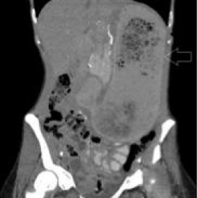 Computed tomography with intravenous and oral contrast agent (coronal)