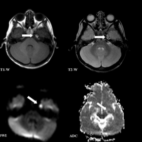 Brain MRI [3-year-old]