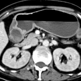 Axial abdominal CT