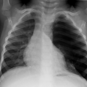 Chest X-ray ap