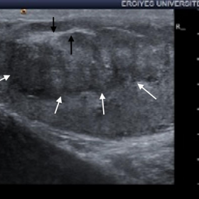 US image of TART located within right testis
