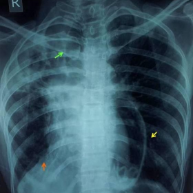 Chest X-Ray PA view