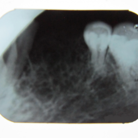 Intra-oral periapical radiograph