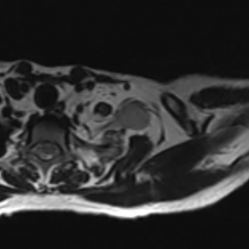 MRI - T2 axial images