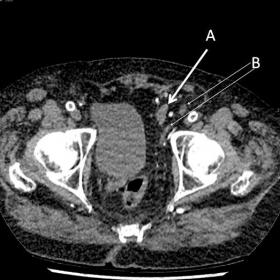 Axial unenhanced CT urinary tract