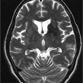 T2W axial MR image