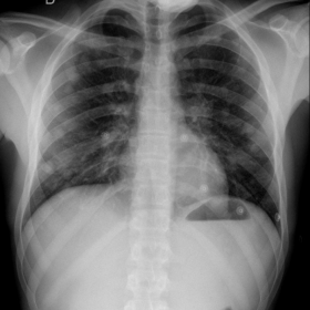 Admission chest X-ray