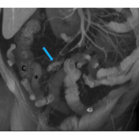 Diverticulosis of the appendix - MRI findings