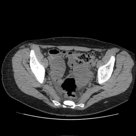 Non-enhanced pelvic CT image