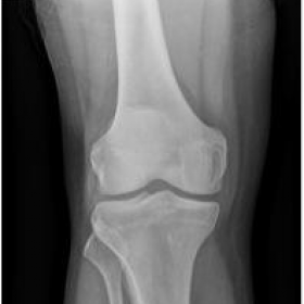 Conventional radiograph of the right knee
