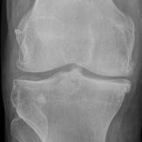 Conventional Radiography of the right knee joint