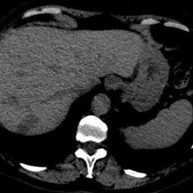 Unenhanced CT of the liver