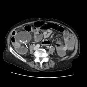 Axial CT image