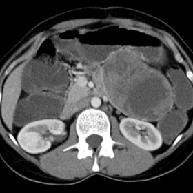 Contrast CT: Axial