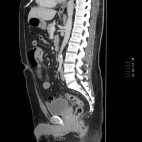 Sagittal abdominal MPR