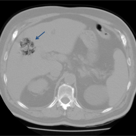 Unenhanced  CT images with lung window settings