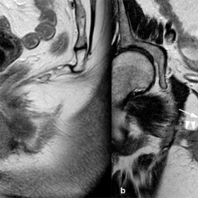 MRI T2w-TSE. Sagittal (a) and coronal (b)