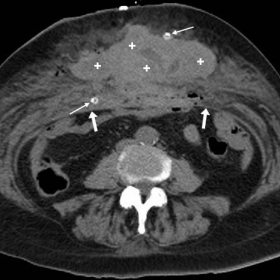 Urgent unenhanced and contrast-enhanced multidetector CT
