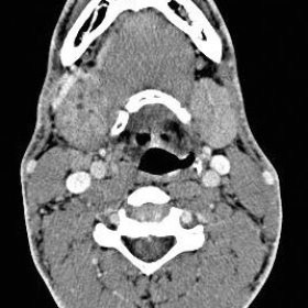 CT after iodinated contrast injection