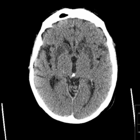 Axial CT brain hypoxic ischaemic encephalopathy
