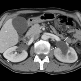 Contrast-enhanced multidetector CT-urography 20 days after surgery