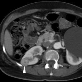 Preoperative contrast-enhanced multidetector CT