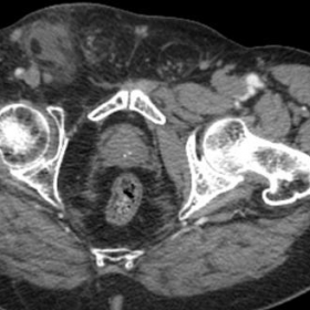 Contrast-enhanced CT of the abdomen. axial image.