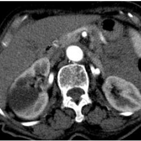 Axial CT with intravenous injection